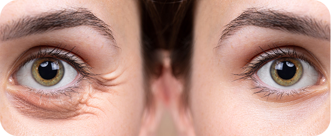Blefaroplastia (Cirurgia de Pálpebra)