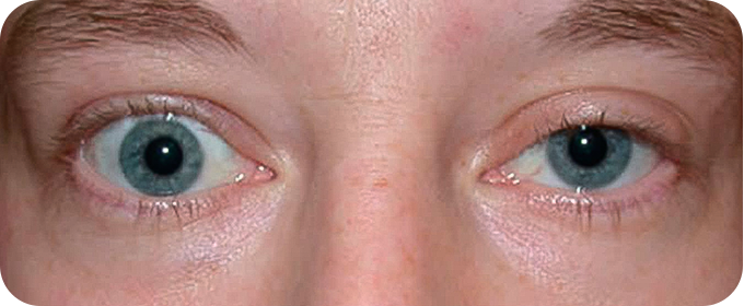 Retração Palpebral